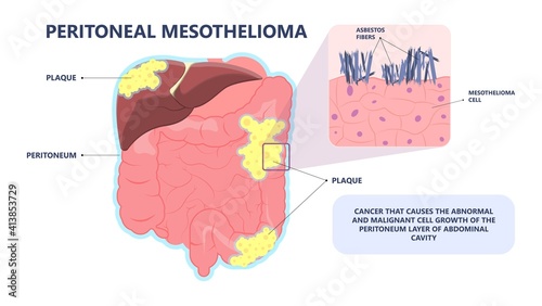 Asbestos breath chest pain testes ascites Hydrocele scrotum Swollen Difficulty fluid pleura testicle tunica vaginalis dust tract safe safety carcinogen smoking hazard danger tissue toxic silica copd