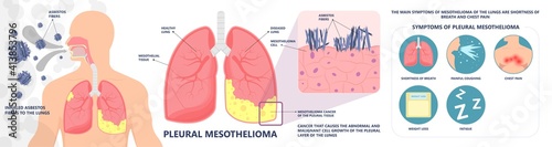 Asbestos breath chest pain testes ascites Hydrocele scrotum Swollen Difficulty fluid pleura testicle tunica vaginalis dust tract safe safety carcinogen smoking hazard danger tissue toxic silica copd