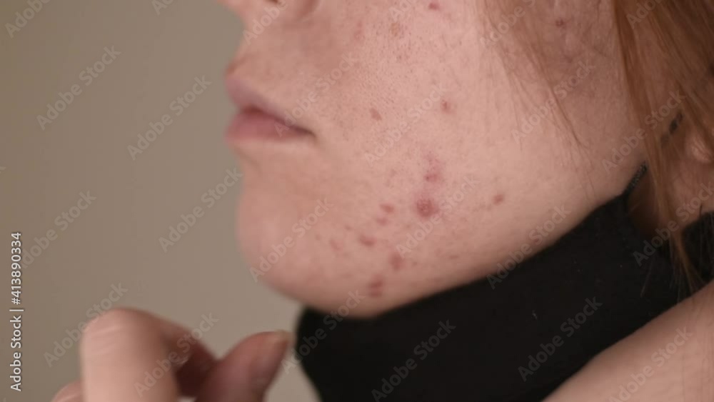 Women with acne and irritation from wearing a mask. Women take off the protective mask. Women with acne and irritation from wearing a mask. Women take off the protective mask.