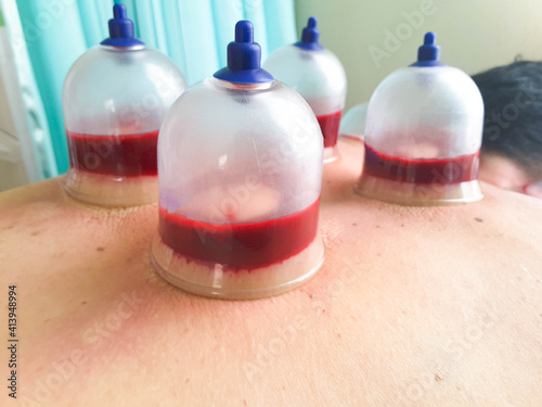 Tarditional Chinese treatment blood cuping theraphy  on back reduce back pain  shoulder pain photo