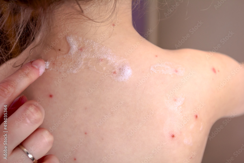 Therapy against the virus of Varicella has measles, chicken pox, rubella Therapy against the virus of Varicella has measles, chicken pox, rubella