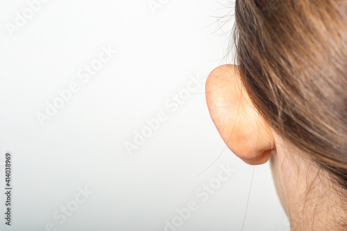 Female ear, lop-eared, protruding, close-up on a light background. Auricle defect. photo