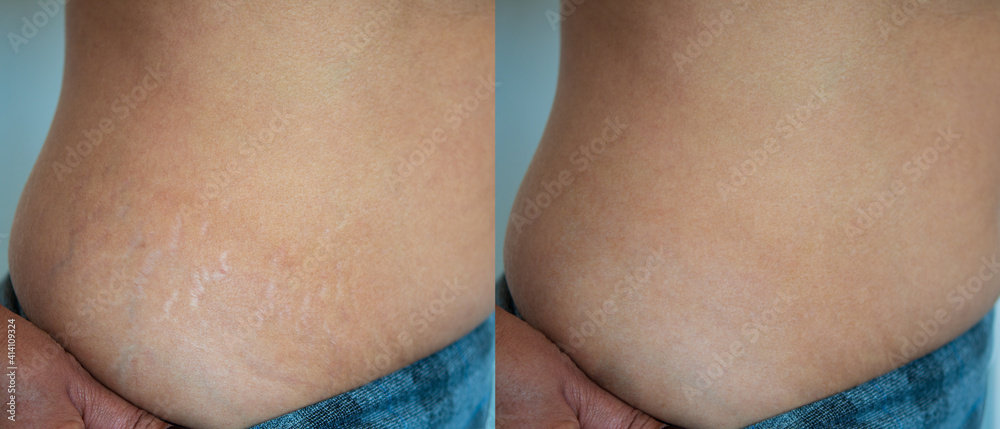 Image before and after skin stretch marks removal treatment.