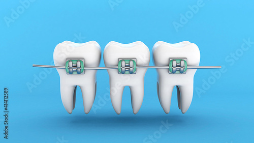 Teeth braces. Teeth alignment. Three white teeth with braces on a blue background. 3d render photo