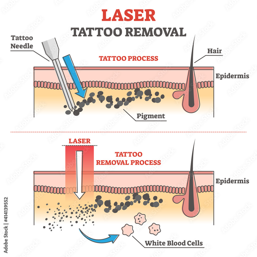 Tattoo Removal in NYC  Best Laser Tattoo Removal in Manhattan