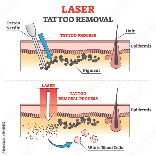 Laser tattoo removal process labeled educational explanation outline concept