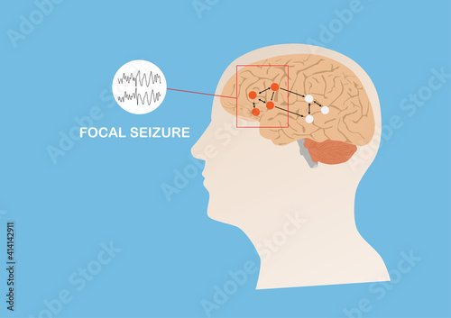 Illustration of abnormal electrical activity causing focal seizure.
