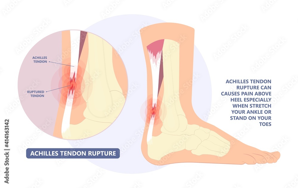 Obraz premium Achilles tendon rupture injury Feet calf test range of motion slight ache problem limb Thompson Simmonds 