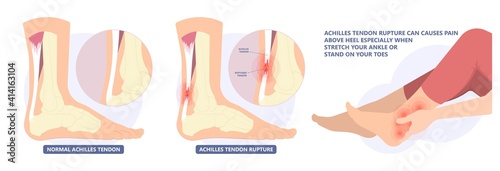 Achilles tendon rupture injury Feet calf test range of motion slight ache problem limb Thompson Simmonds	