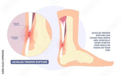 Achilles tendon rupture injury Feet calf test range of motion slight ache problem limb Thompson Simmonds	