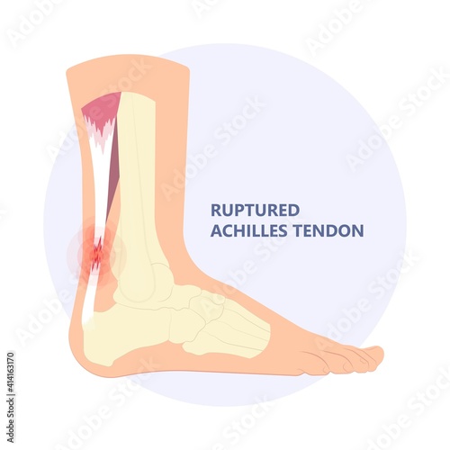 Achilles tendon rupture injury Feet calf test range of motion slight ache problem limb Thompson Simmonds	