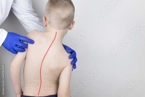 A little boy at the doctor's appointment with back pain. Treatment of spinal deformity and stoop. Osteoporosis, kyphosis, lordosis, or scoliosis. photo