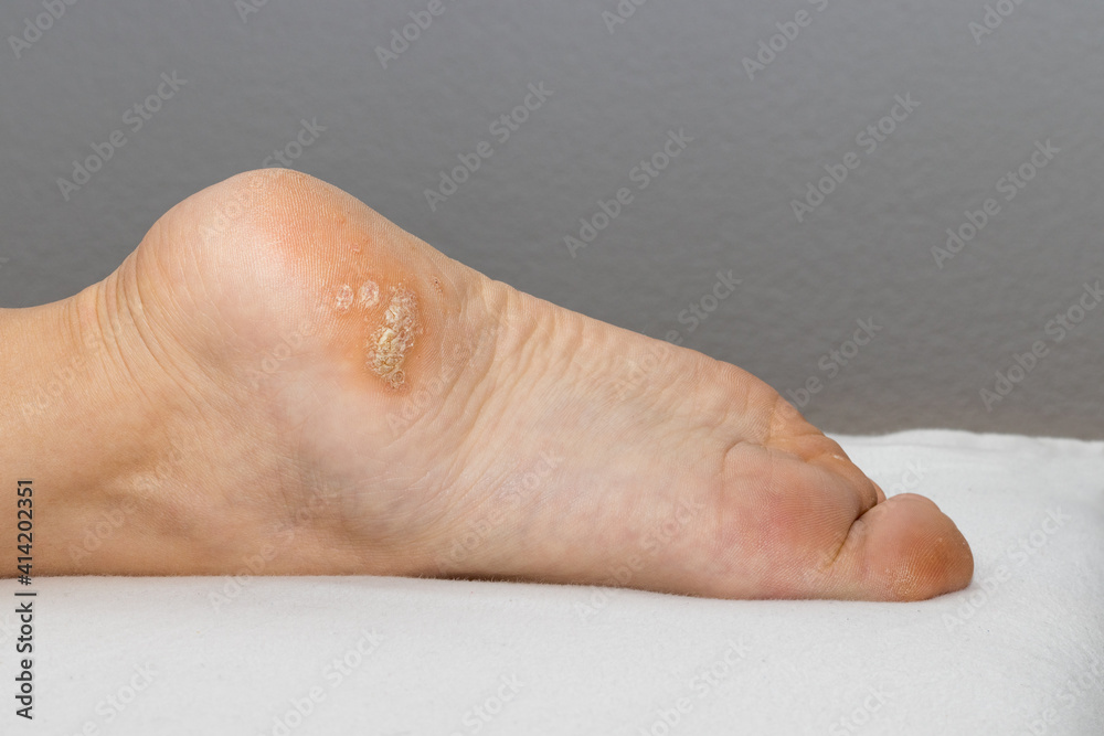 Plantar wart close up on the bottom of a female foot heel caused by the