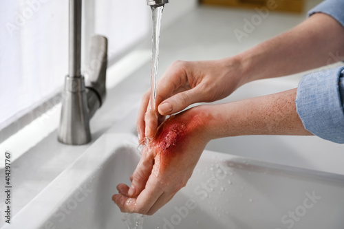 Woman holding hand with burn under flowing water indoors, closeup photo