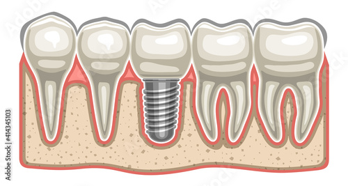 Vector illustration of Dental Implant, 5 human teeth in a row and ceramic artificial tooth with screw in bone jaw, decorative horizontal sticker for professional denture clinic on white background.
