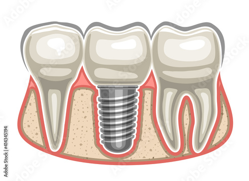 Vector illustration of Dental Implant, 3 human teeth in a row and ceramic artificial tooth with screw in bone jaw, decorative signage for professional denture clinic on white background.