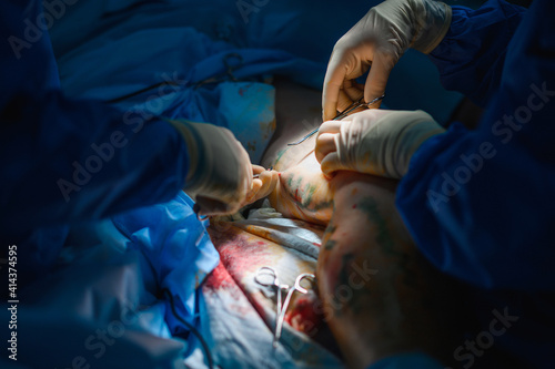 Phlebectomy operation. Surgical removal of veins