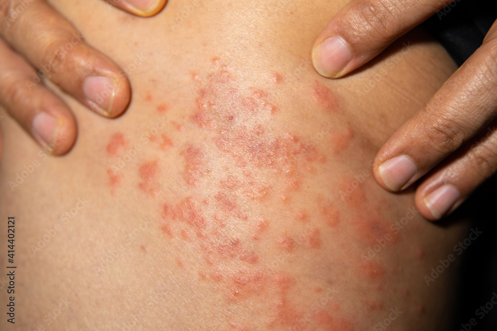 Men scratching legs suffering strong allergy skin itchy symptom, Allergy rash and Health problem. Men scratching legs suffering strong allergy skin itchy symptom, Allergy rash and Health problem.
