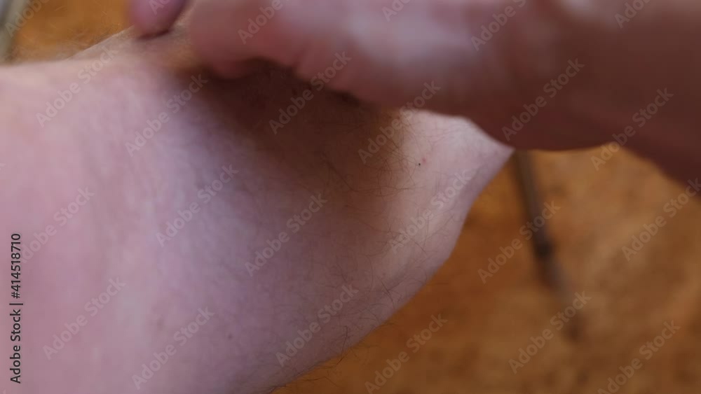 A man scratches red pimples on his shins, close-up