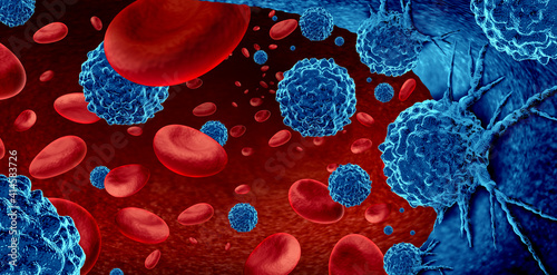 Cancer in the blood outbreak and treatment for malignant cells in a human body caused by carcinogens and genetics with a cancerous cell as an immunotherapy and leukemia or lymphoma symbol and medical  photo