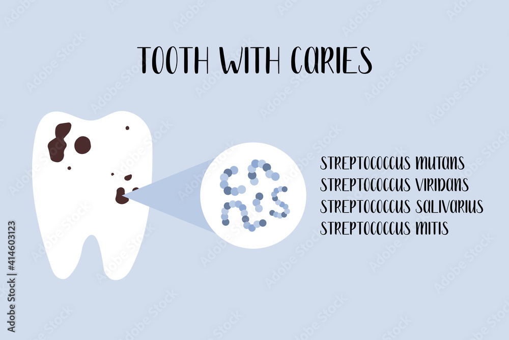 Tooth with caries. Plaque bacteria Streptococcus mutans, Streptococcus