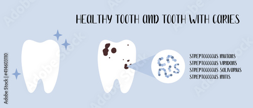 Healthy tooth and tooth with caries. Plaque bacteria: Streptococcus mutans, Streptococcus viridans. Oral care. Dental cavity, teeth hygiene. Vector flat cartoon illustration photo