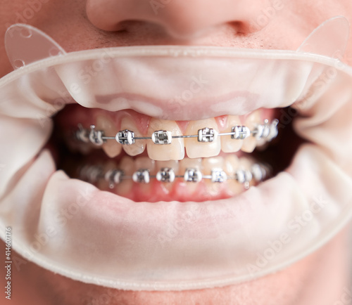 Close up of young man demonstrating teeth with wired metal braces. Healthy straight teeth with orthodontic braces and white cofferdam. Concept of dentistry, stomatology and orthodontic treatment.