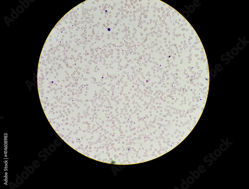 Leukopenia also known as leukocytopenia is a decrease in the number of white blood cells leukocytes found in the blood microscopic 40x objective image photo