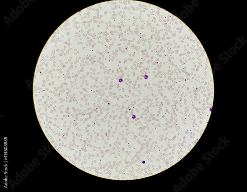 Microscopic blood film show low count of rbc wbc platelets called pancytopenia photo