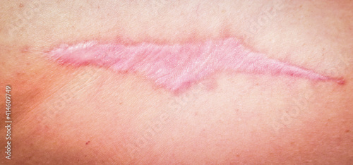 Hypertrophic scars (cicatrix) on the back, muscle tissue transplant, Collagen synthesis. Close-up. Selective focus.
