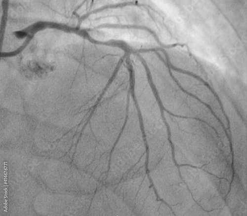 Coronary angiogram , medical x-ray for heart disease. Coronary artery disease.	 photo