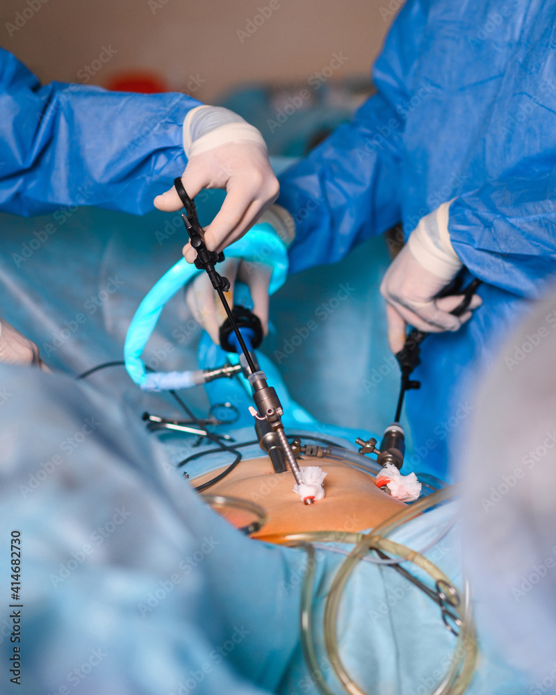 Endoscopic surgery to remove the uterus Stock Photo Adobe Stock