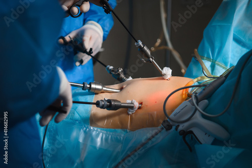 Endoscopic surgery to remove the uterus
