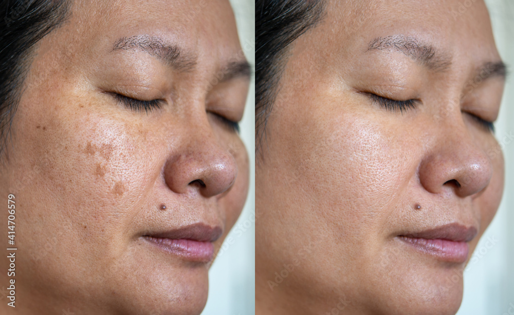Image before and after spot melasma pigmentation facial treatment on