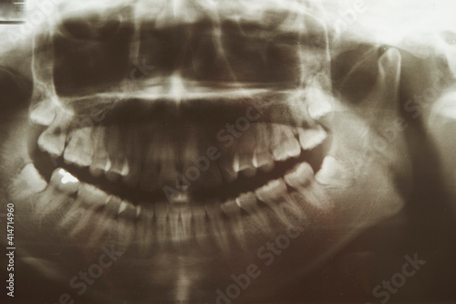Tooth x-ray picture in hospital