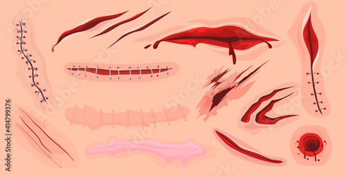 Human skin scars, cuts and bloody wounds flat set for web design. Cartoon ruptures in body tissue isolated vector illustration collection. Injury and traumatology concept