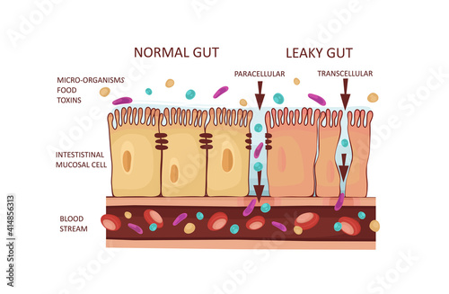 Leaky Gut Syndrome or Intestinal Permeability Diagram. Autoimmune disorder. Vector illustration