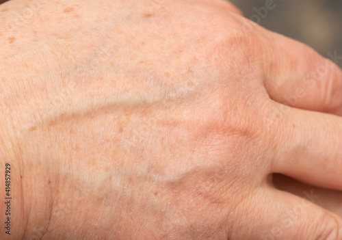 veins on the skin of the hands