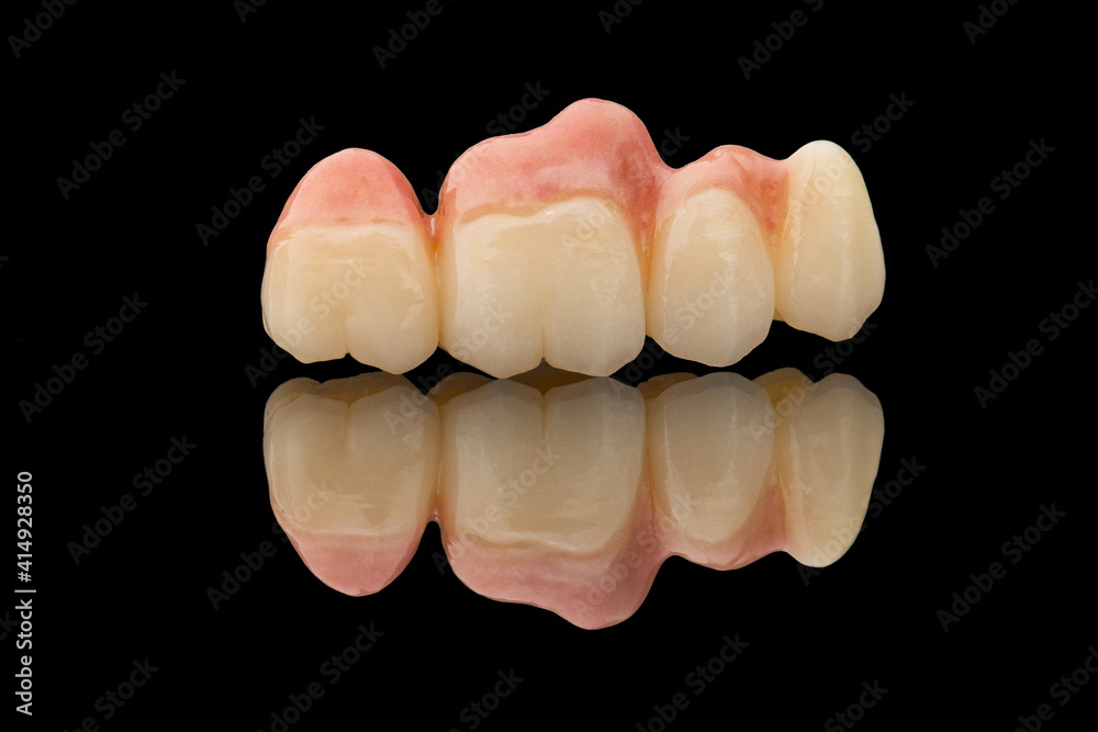 Dental bridge of 4 teeth on artificial gums. Close-up photo of ceramic