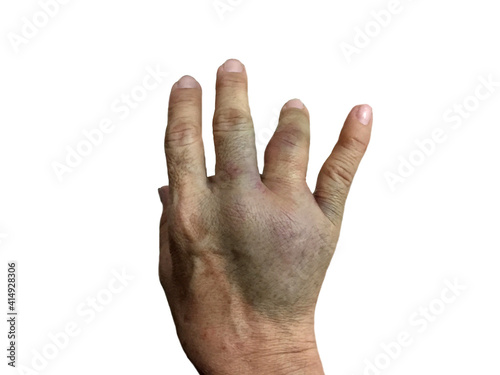 Hands that are severely bruised and swollen