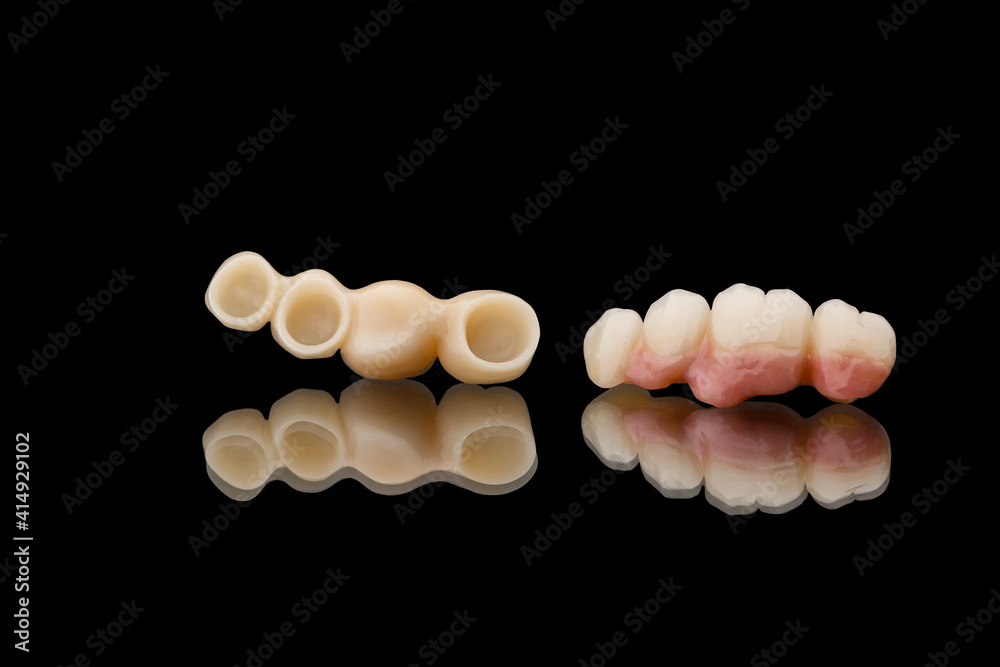 Two dental bridges of four teeth. Close-up photo of ceramic teeth crowns isolated on black glass background. Tooth recovery with implant. Dentistry conceptual photo. Prosthetic dentistry. Two dental bridges of four teeth. Close-up photo of ceramic teeth crowns isolated on black glass background. Tooth recovery with implant. Dentistry conceptual photo. Prosthetic dentistry.