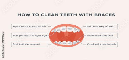 How to clean teeth with braces vector flat information banner template with text space. Mouth with dental braces and advises how to clean braces. Dental and orthodontic infographic.