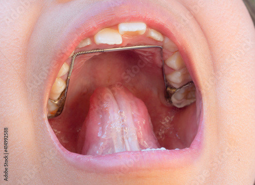 wearing spacer