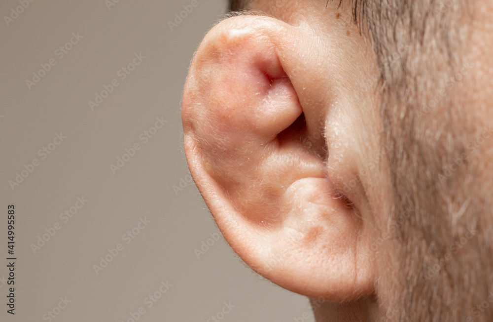 Damaged and broken cartilage of the ear. Photography of most common