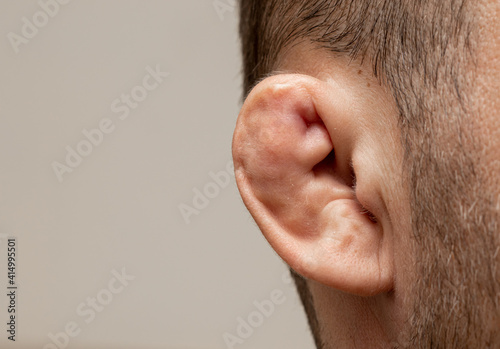 Canvas-taulu Photography of anatomy of the defective ear.