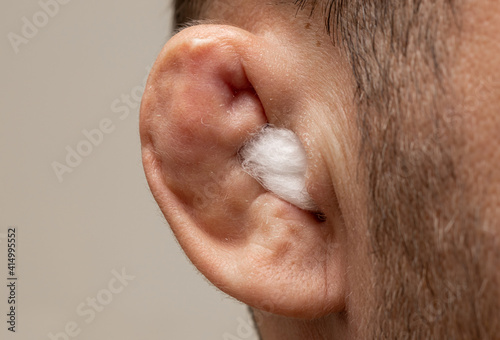 Ear of fighter close-up. Anatomy Disabled ear with medical cotton wool.