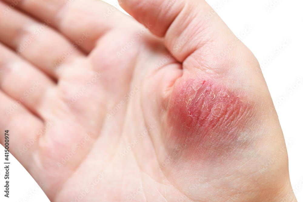 Atopic dermatitis (AD), also known as atopic eczema, is a type of skin inflammation (dermatitis) on the fingers. Atopic dermatitis (AD), also known as atopic eczema, is a type of skin inflammation (dermatitis) on the fingers.
