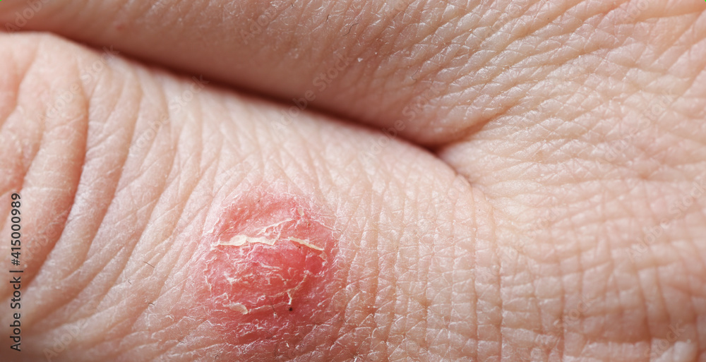 Atopic dermatitis (AD), also known as atopic eczema, is a type of skin inflammation (dermatitis) on the fingers. Atopic dermatitis (AD), also known as atopic eczema, is a type of skin inflammation (dermatitis) on the fingers.