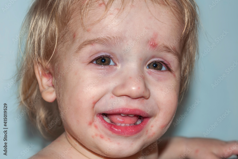 Chickenpox disease, with fever and runny nose. Boy sick on his face. Chickenpox virus, chicken pox outbreak in children.