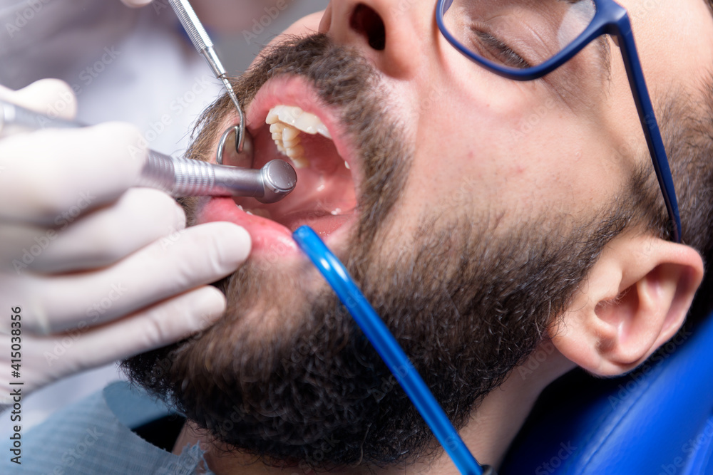 Dentist drilling a tooth with a turbine. Saliva ejector is placed in a